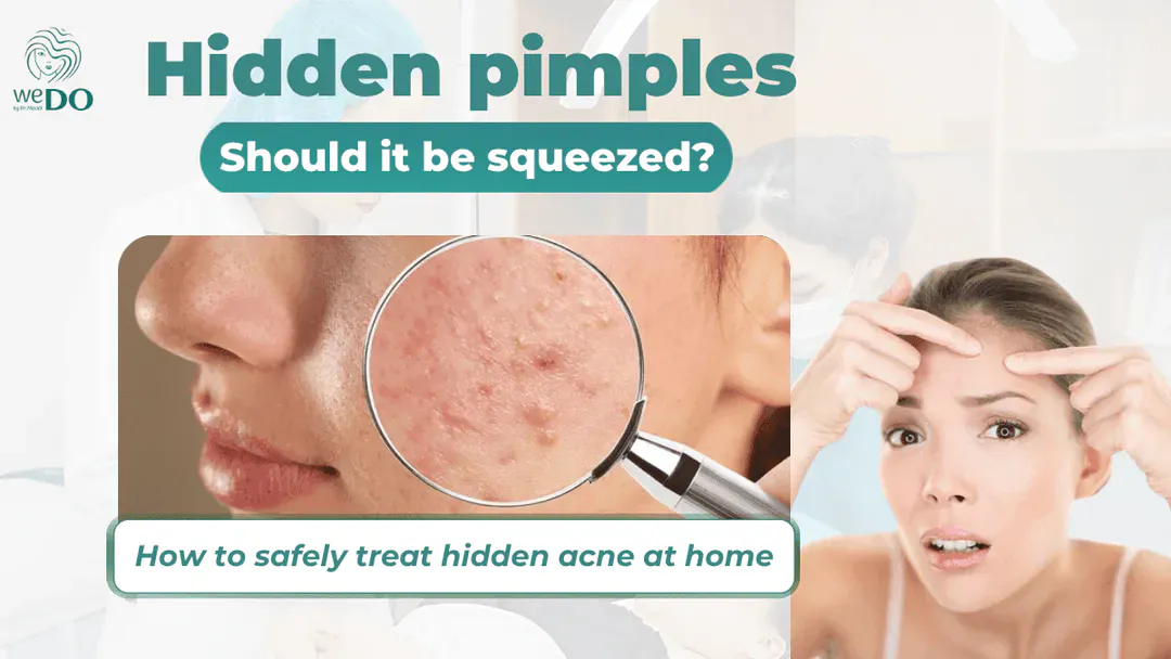 Should hidden pimples be squeezed? Safe methods for treating hidden pimples at home.