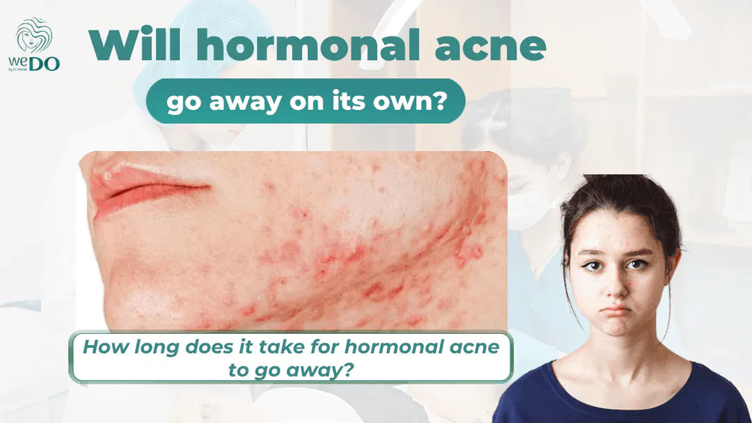 Will hormonal acne go away on its own? How long does it take?