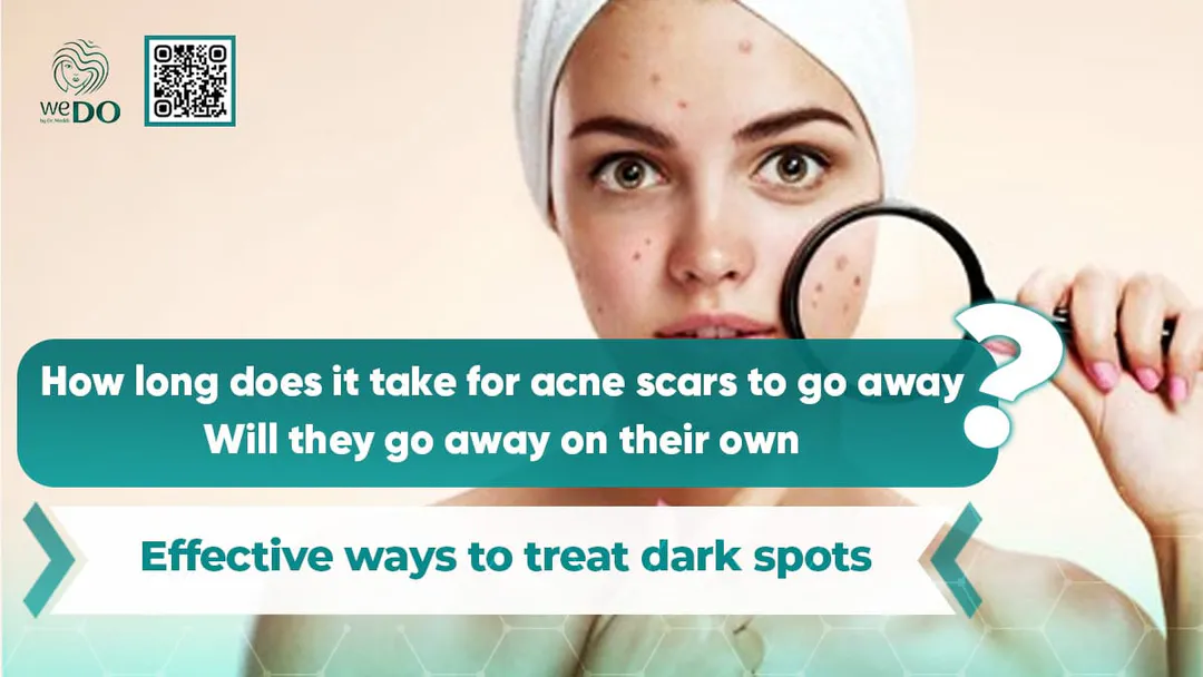 How long does it take for acne scars to go away? Will they go away on their own? Effective ways to treat dark spots