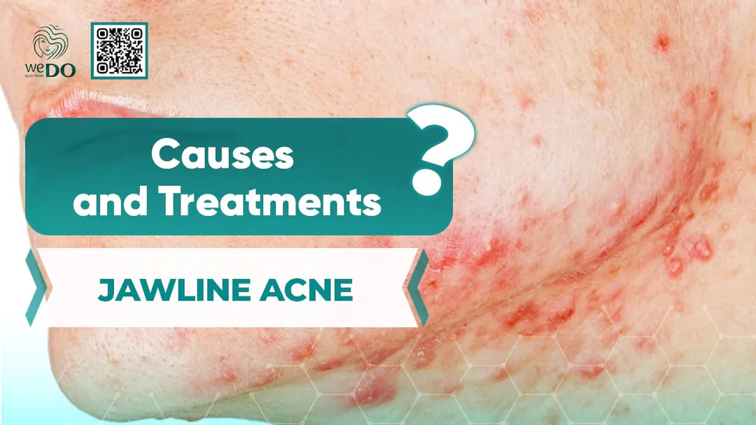 Acne on the jaw – Characteristics, causes and tips to clear acne