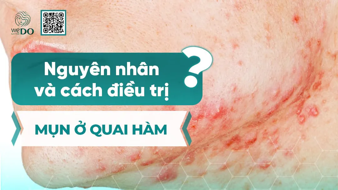 Mụn ở quai hàm – Đặc điểm, nguyên nhân và bí quyết sạch mụn