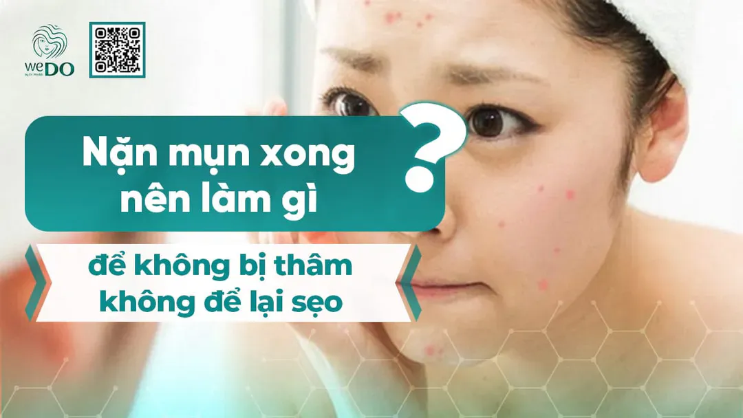Nặn mụn xong nên làm gì để không bị thâm, không để lại sẹo