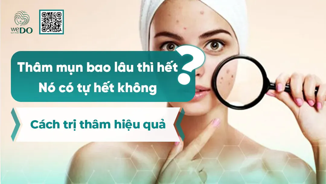 Thâm mụn bao lâu thì hết? Nó có tự hết không? Cách trị thâm hiệu quả