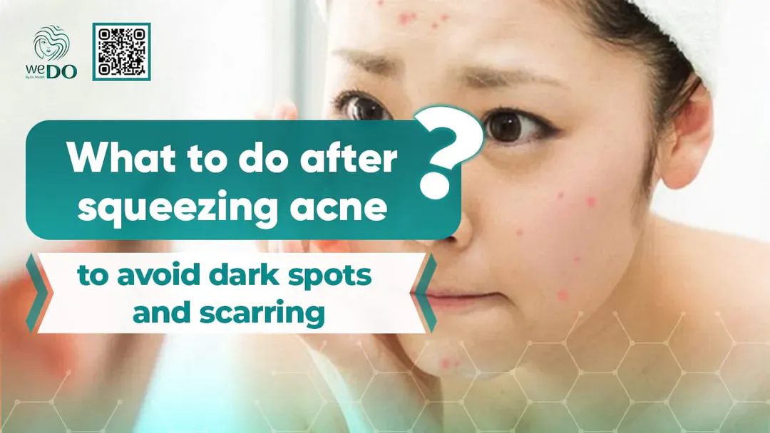 What to do after squeezing acne to avoid dark spots and scarring