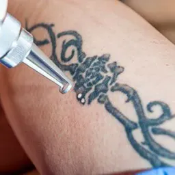 A comparison of Q-SWITCHED ND YAG laser technologies for tattoo removal