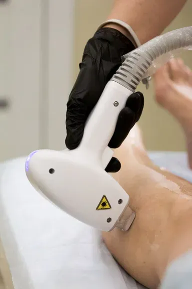 Công nghệ OTP - light SHR (Super Hair Removal)