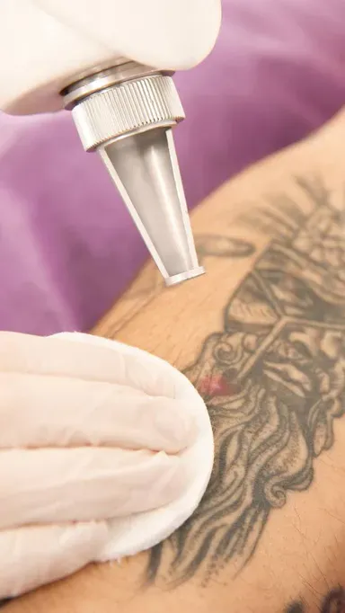 Ideal customers for Q-SWITCHED ND YAG laser tattoo removal