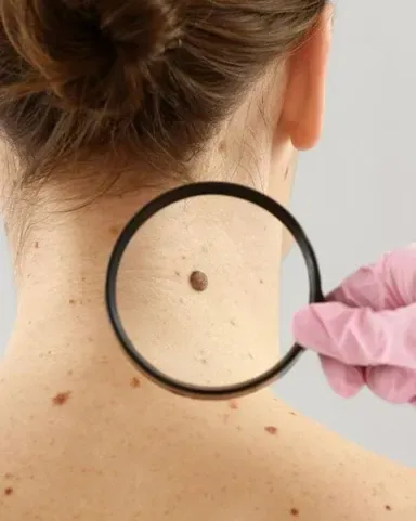 Risk of skin cancer from moles