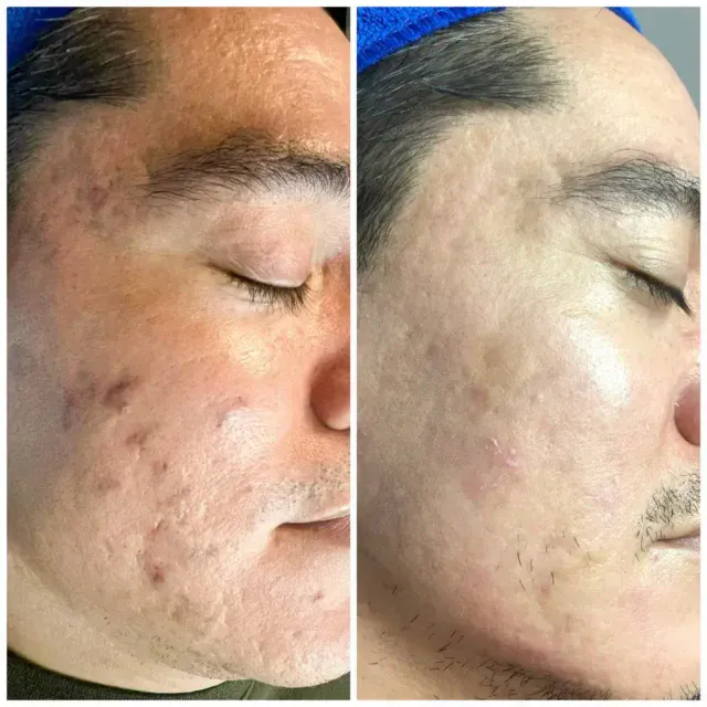 Skin Recovery Journey with Mr. Daniel