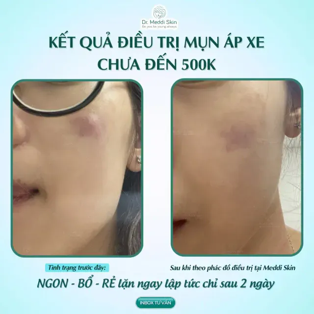TREATMENT RESULTS OF KHANH VO ACNE ABSCESS - LESS THAN 500K