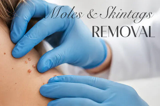 REMOVAL OF MOLES, SKIN TAGS, WARTS, AGE SPOTS, AND CYSTS.