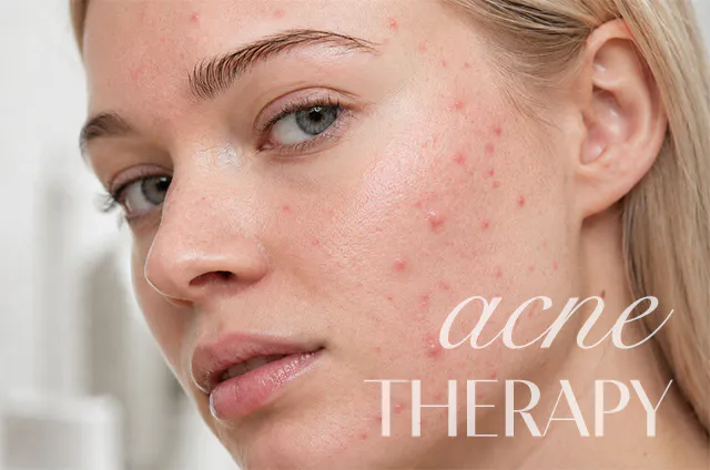 MEDICAL ACNE TREATMENT