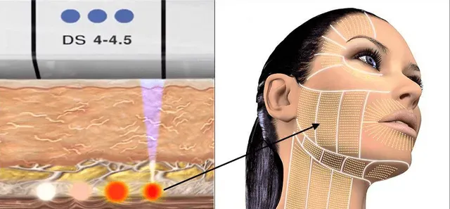 How Does Ultherapy Work?