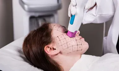 Nhóm săn chắc bằng sóng RF đơn cực: Thermage