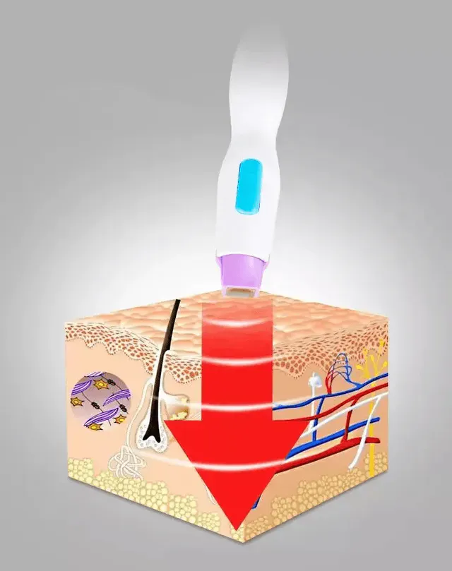 How Does Thermage Work?