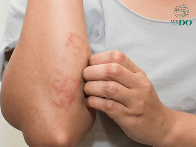 Atopic dermatitis