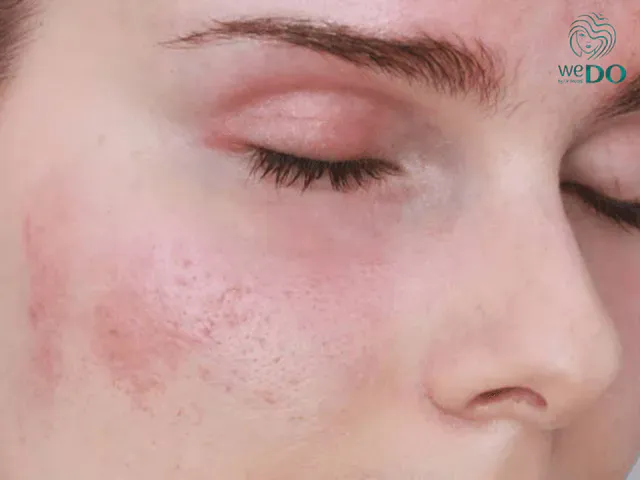 Contact dermatitis