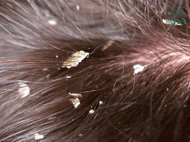 Dandruff