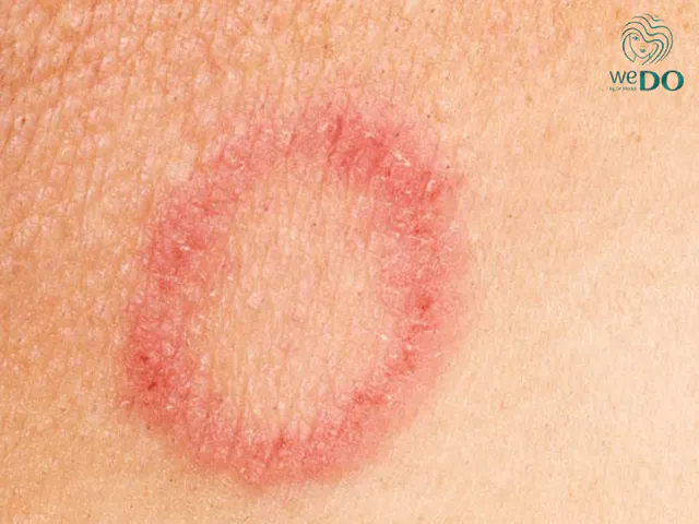 Skin fungus