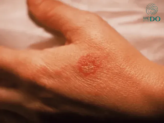 Eczema