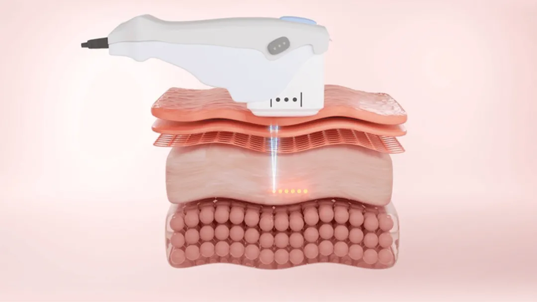 Cách thức hoạt động: Sử dụng sóng siêu âm