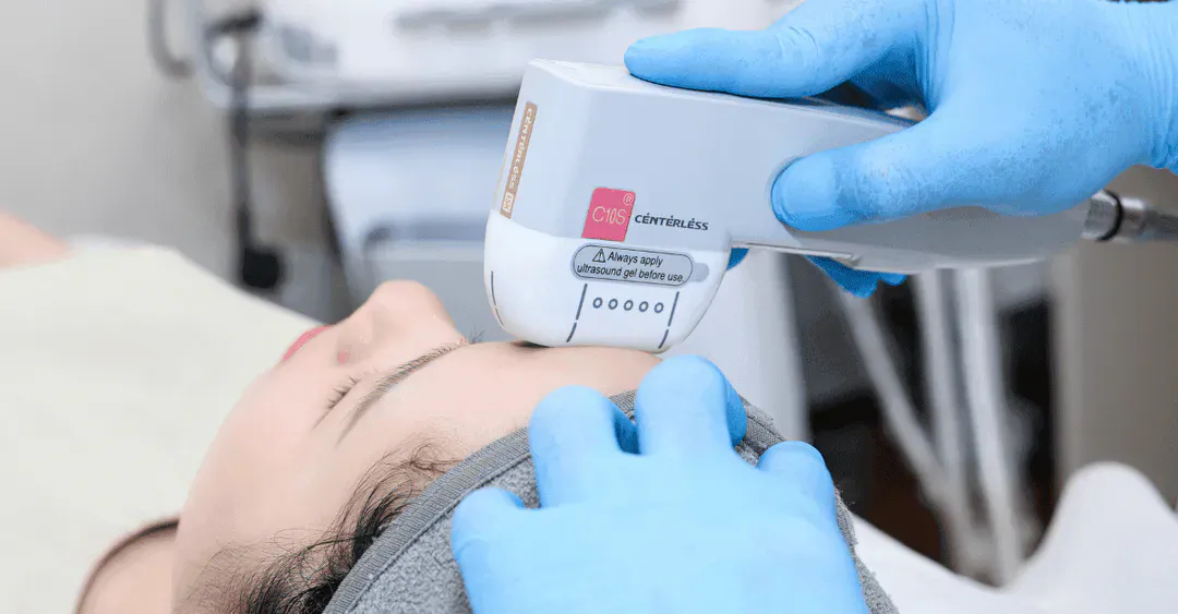 Nâng cơ HIFU: sóng siêu âm hội tụ tác động tầng SMAS