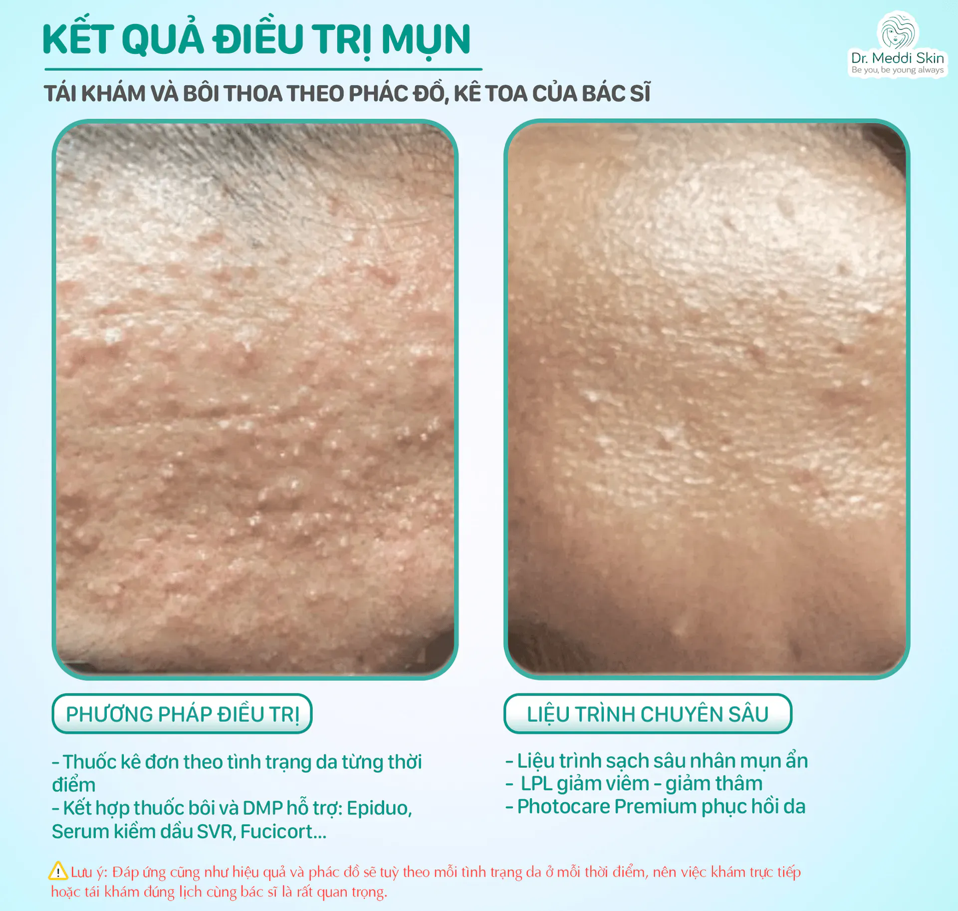 Kết quả trước – sau: Mụn viêm, thâm đỏ sau mụn
