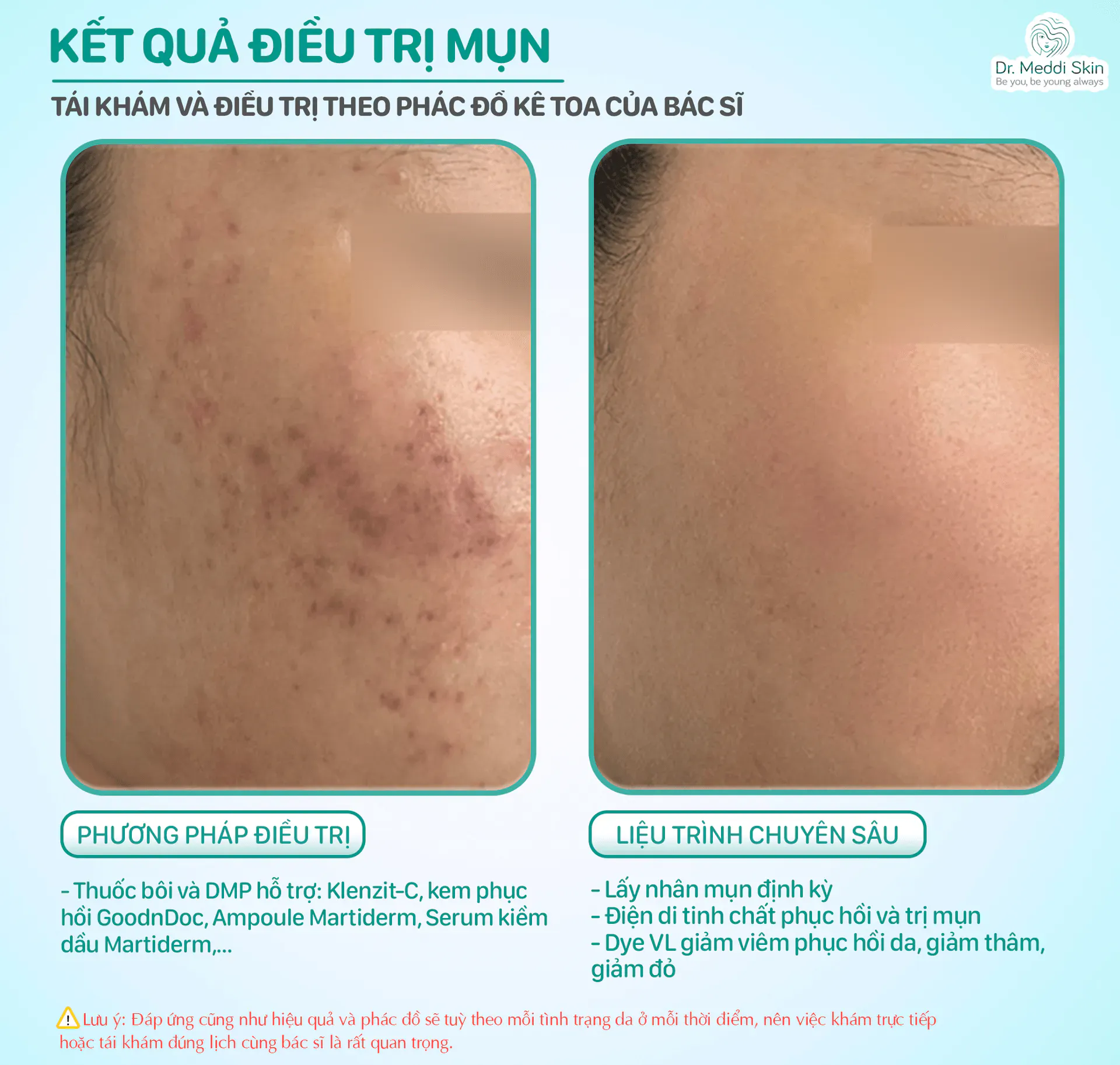 Kết quả trước – sau: Mụn ẩn, da dầu xỉn màu