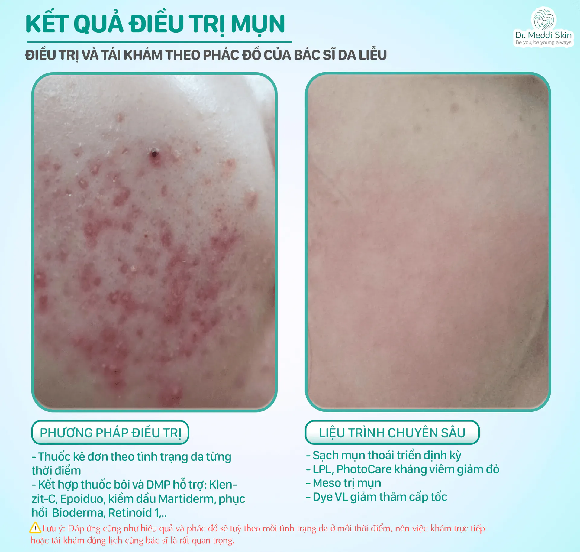 Kết quả trước – sau điều trị mụn viêm bằng laser tại WeDo