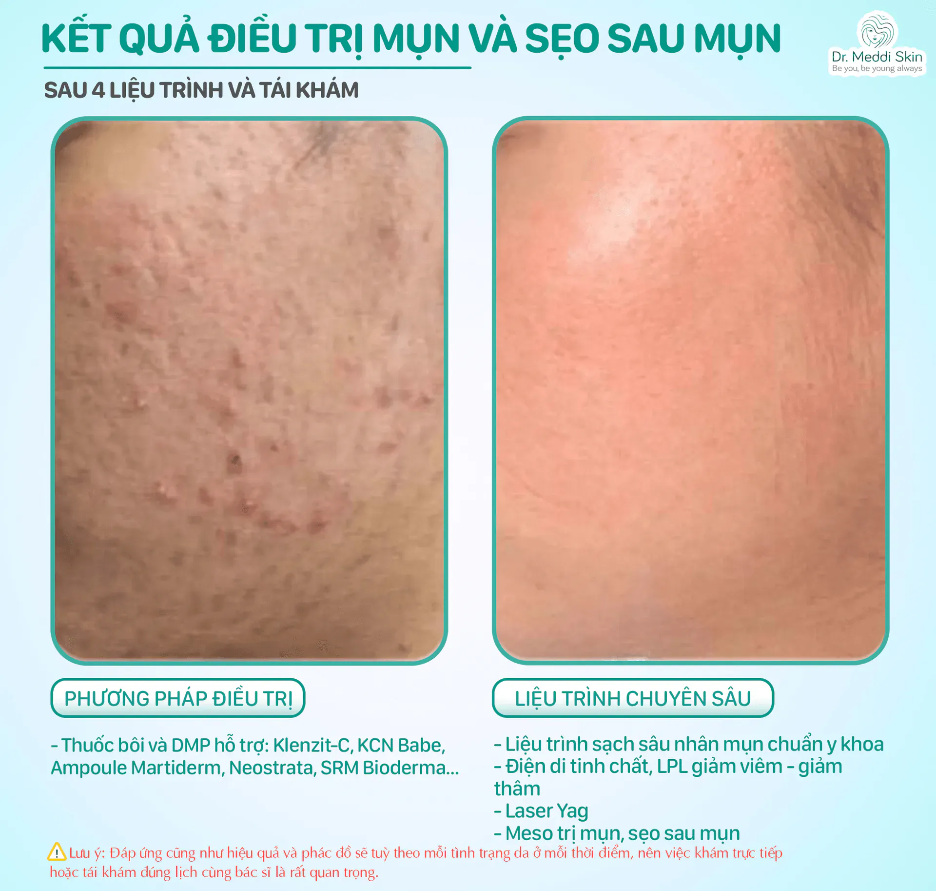 Kết quả trước – sau: Sẹo rỗ nông sau mụn lâu năm