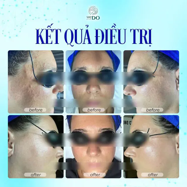 JOURNEY TO "REMOVE" HIDDEN ACNE, GET RADIANT SKIN BACK at WeDo
