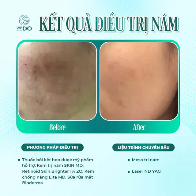 No more hiding behind heavy makeup! After just one treatment for melasma at WEDO, my skin has undergone a complete transformation.