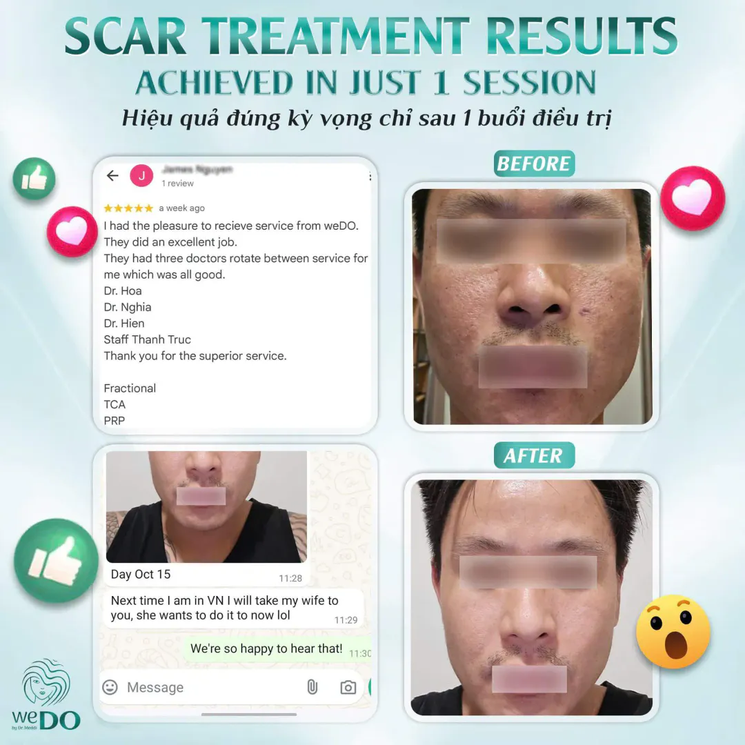 Only 1 SESSION - 1 TREATMENT for acne scars - James Nguyen - Vietnamese expatriate achieves expected results! 🥰