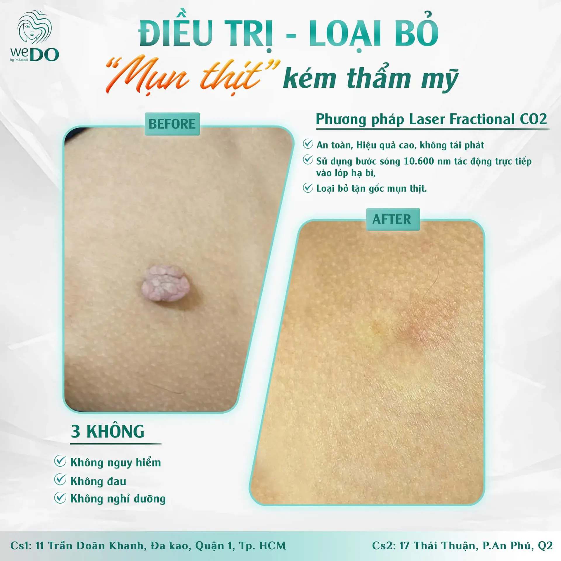 Bác sĩ ra tay – mụn thịt bay ngay!
