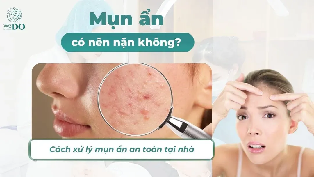 Mụn ẩn có nên nặn không? Cách xử lý mụn ẩn an toàn tại nhà