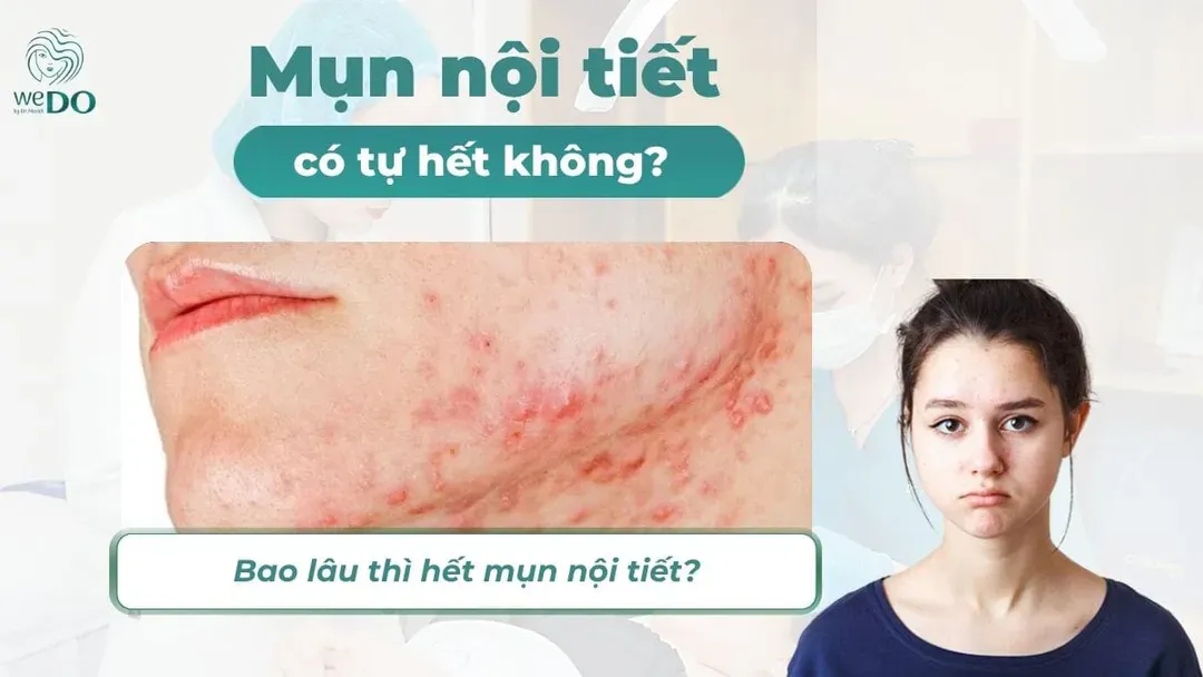 Mụn nội tiết có tự hết không? Bao lâu thì khỏi?