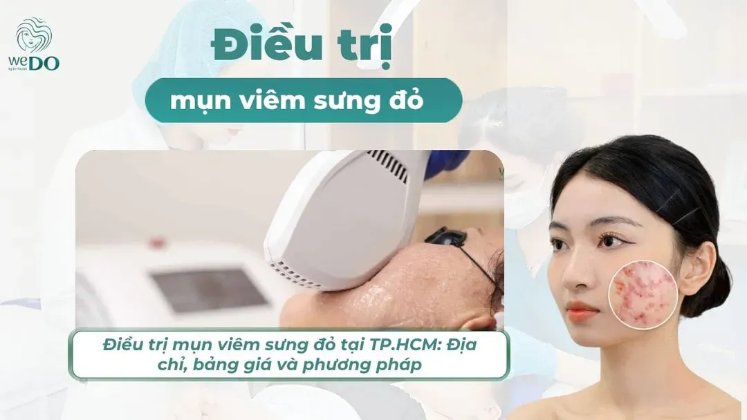 Trị MỤN VIÊM sưng đỏ tại TP.HCM: Địa chỉ, Bảng giá & Phương pháp