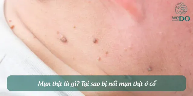 What are skin tags? Why do skin tags appear on the neck?