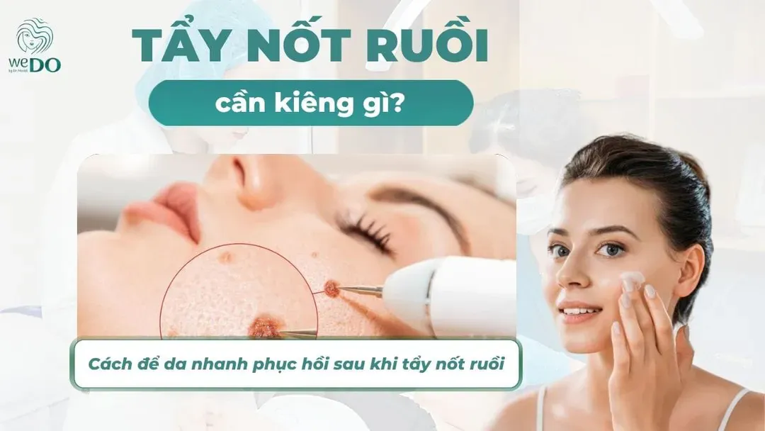 Tẩy nốt ruồi kiêng gì để da nhanh hồi phục và đẹp hơn?
