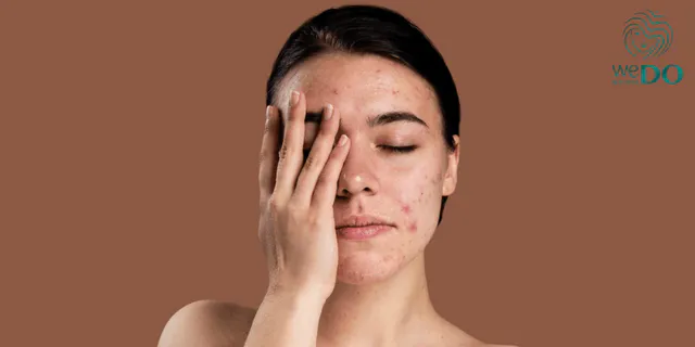Những hiểu lầm thường gặp về mụn trứng cá và mụn viêm