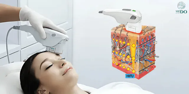 Cơ chế hoạt động của máy Hifu