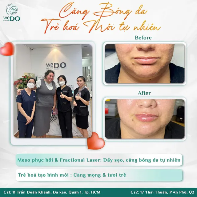 Restore smooth skin – youthful lips after one treatment session
