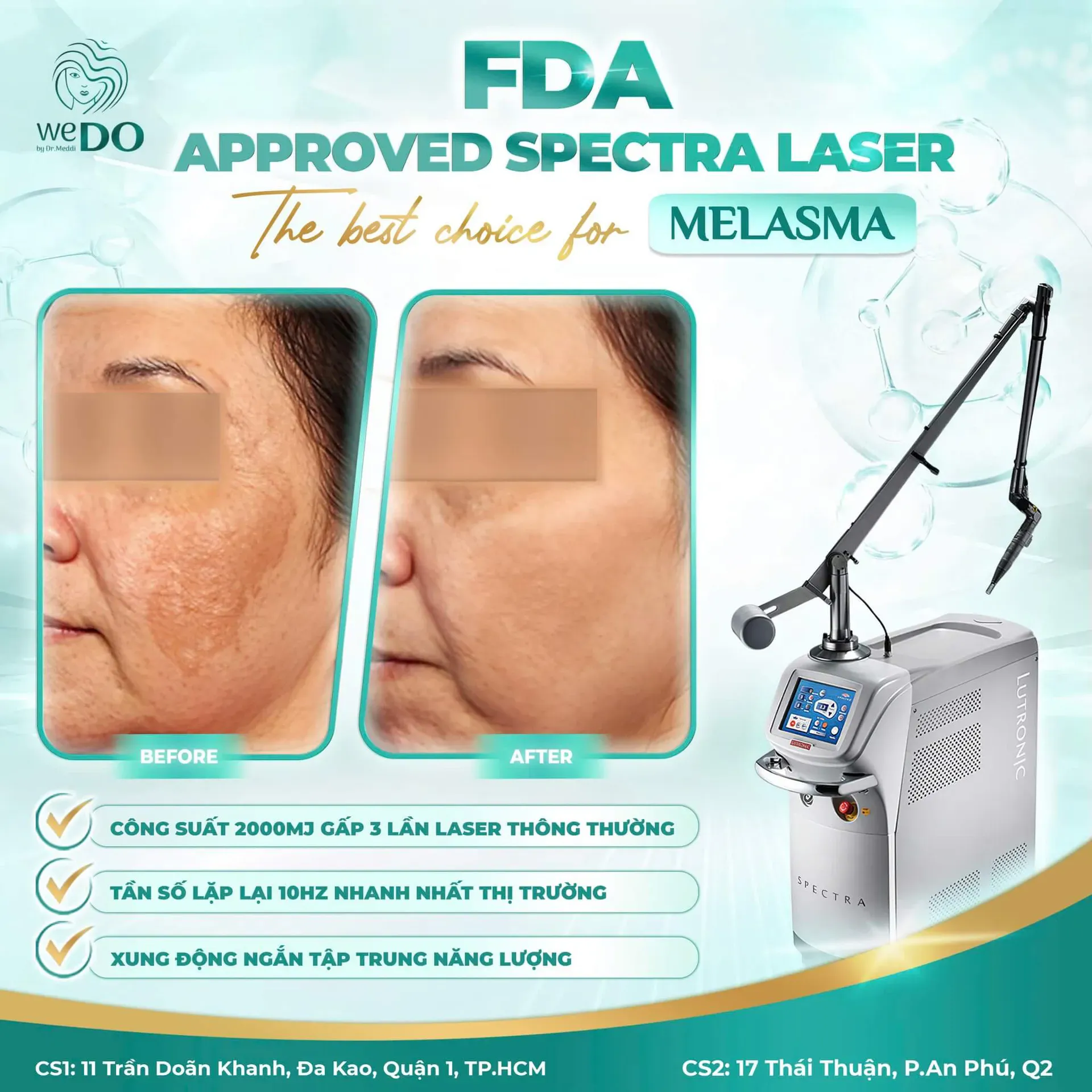 FDA-Approved Spectra Laser – The Best Choice for Melasma