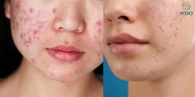 Mụn là tình trạng viêm cần được điều trị trước. Thâm là vết sắc tố hình thành sau mụn, chỉ nên xử lý khi da đã hết mụn