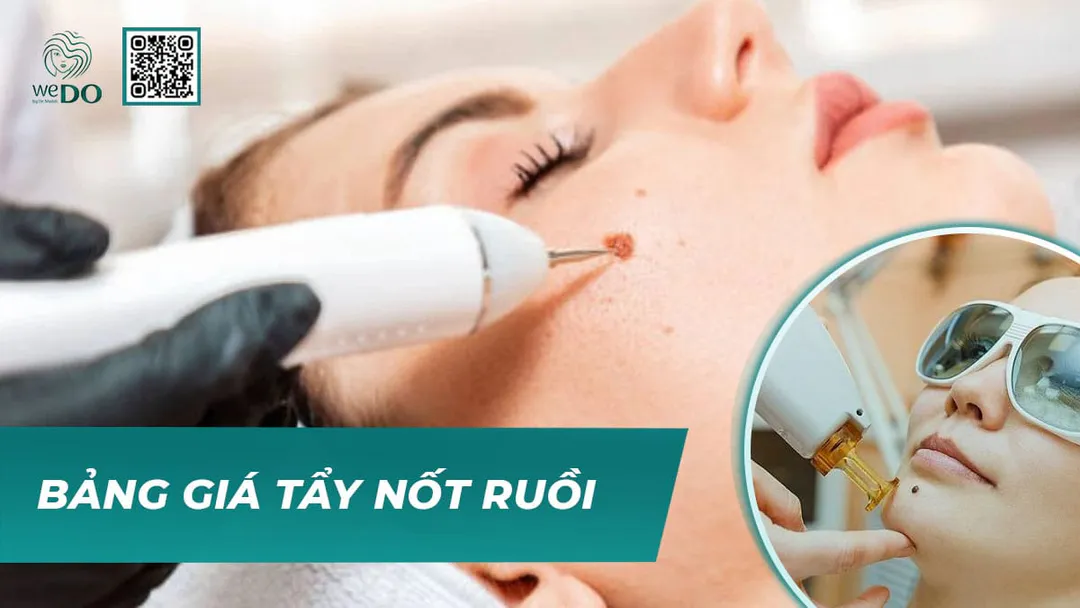 Tẩy nốt ruồi bao nhiêu tiền? Bảng giá chi tiết dịch vụ tẩy nốt ruồi
