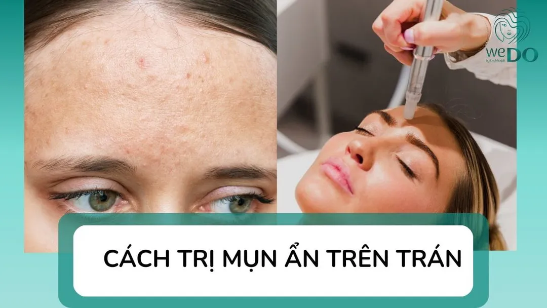 Bị nổi mụn ẩn trên trán phải làm sao? Cách trị mụn ẩn trên trán