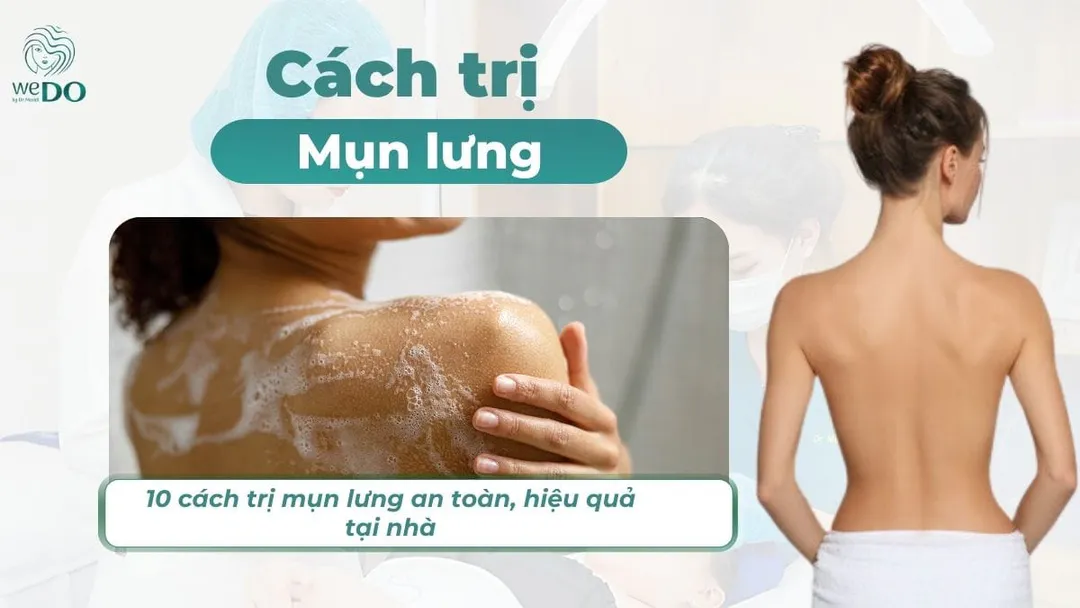 10 cách trị mụn lưng an toàn, hiệu quả tại nhà