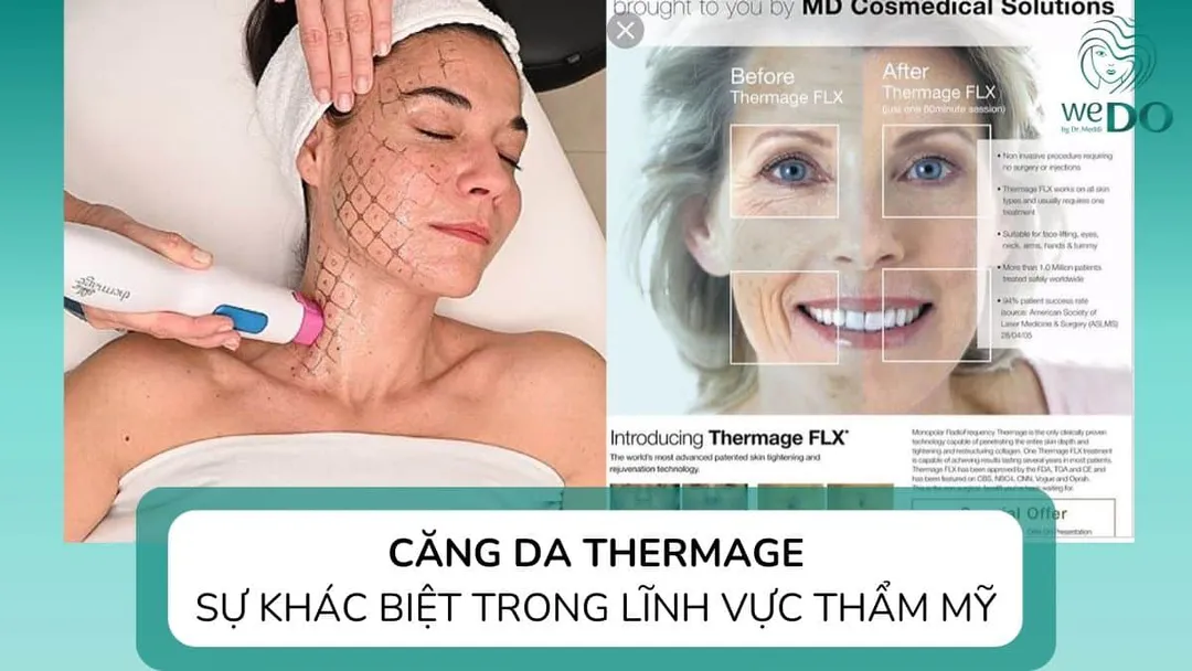 Căng da Thermage: Sự khác biệt trong thẩm mỹ làm đẹp