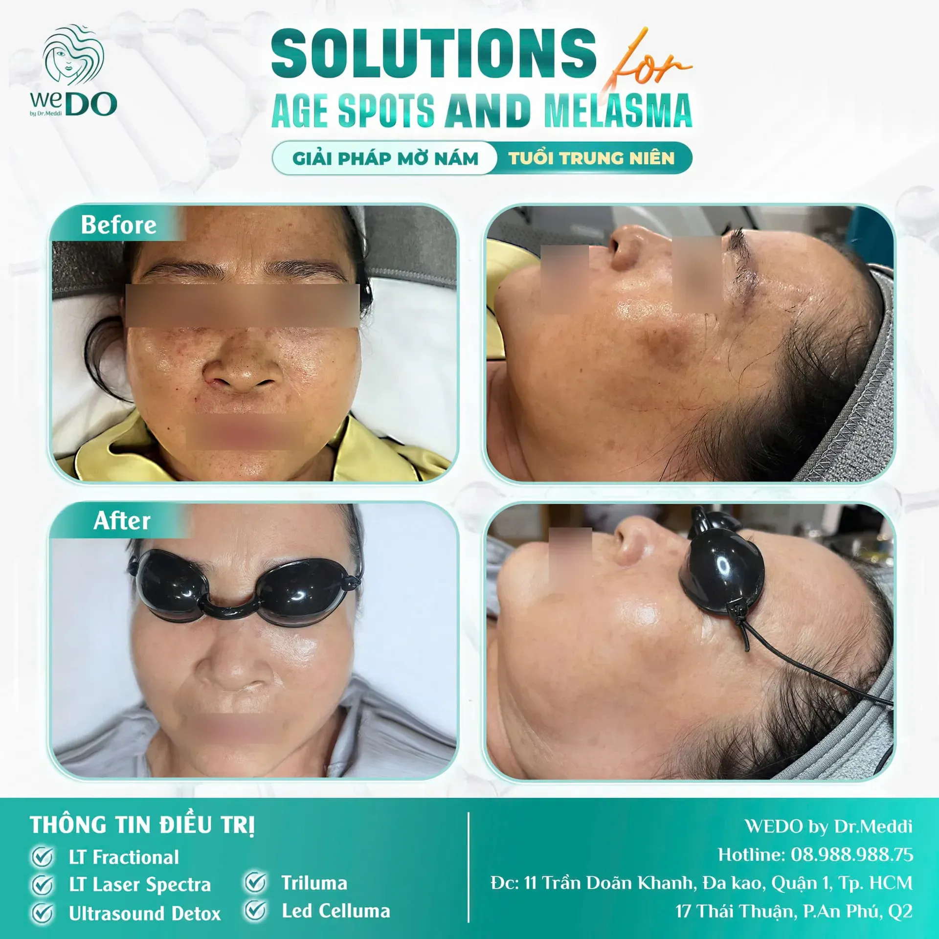 Don’t let dark spots stick like an ex – Eliminate 80% of them!