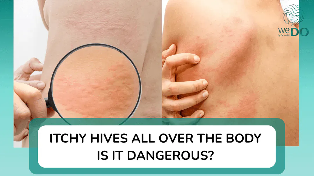 Is hives all over the body dangerous? How to stop itching?